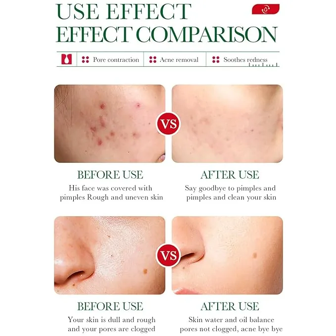 Ácido Salicílico Elimina Acne y Marcas de Acne