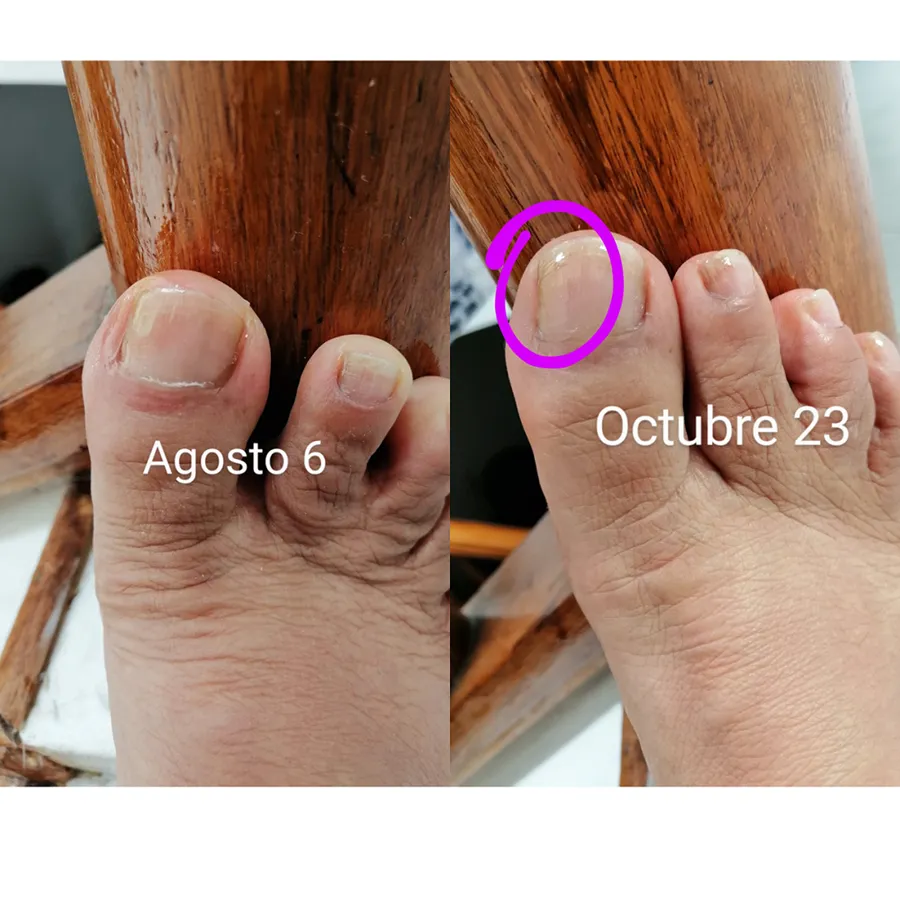 Tratamiento Efectivo Para Los Hongos De Las Uñas